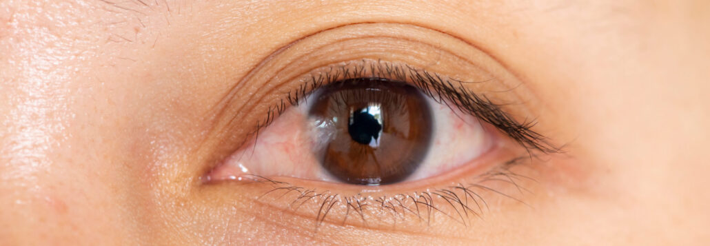 pterygium
